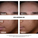 NEUTROGENA BLACKHEADS DAILY SERUM ACNE TREATMENT 30ML - Image 2